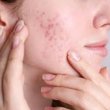 breakouts skin acne